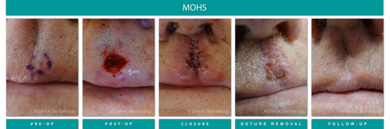 Mohs Surgery Chicago, IL