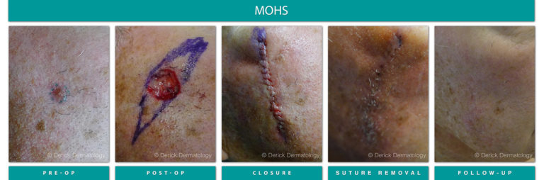 Mohs Surgery Chicago, IL