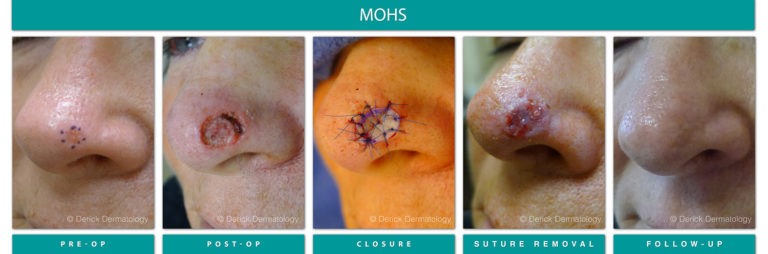 Mohs Surgery Chicago, IL