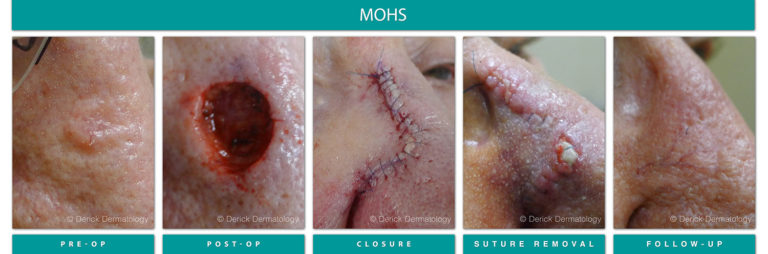 Mohs Surgery Chicago, IL