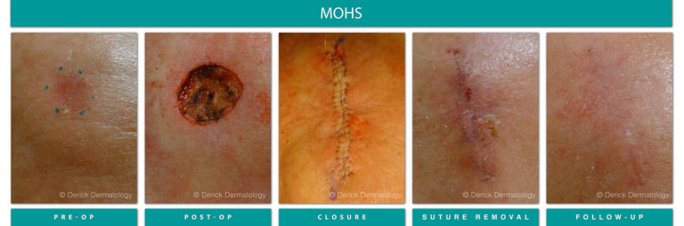 Mohs Surgery Chicago, IL