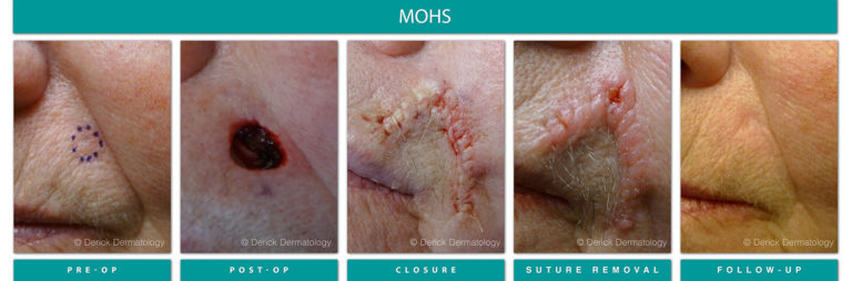 Mohs Surgery Chicago, IL