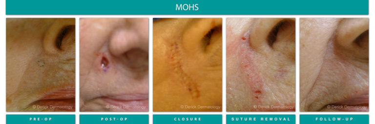 Mohs Surgery Chicago, IL